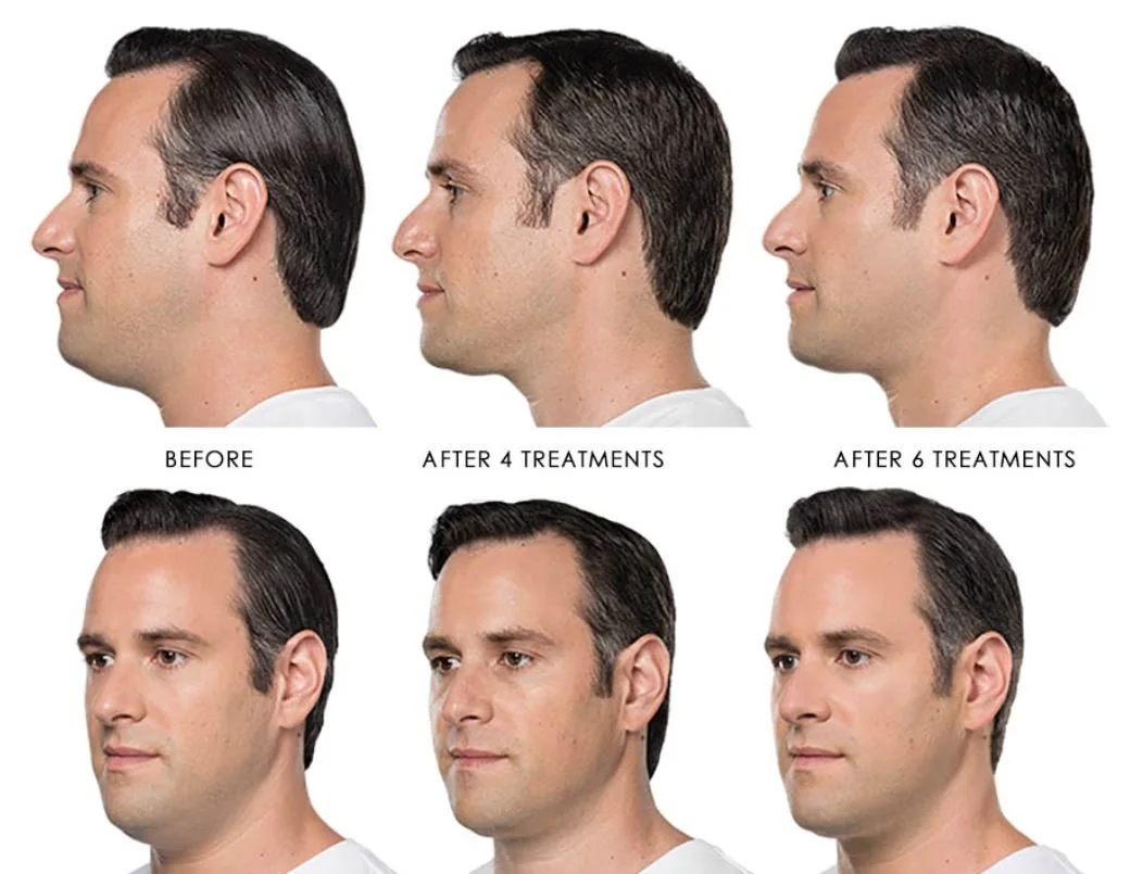 Kybella Fort Lauderdale: Double Chin Reduction Without Surgery
