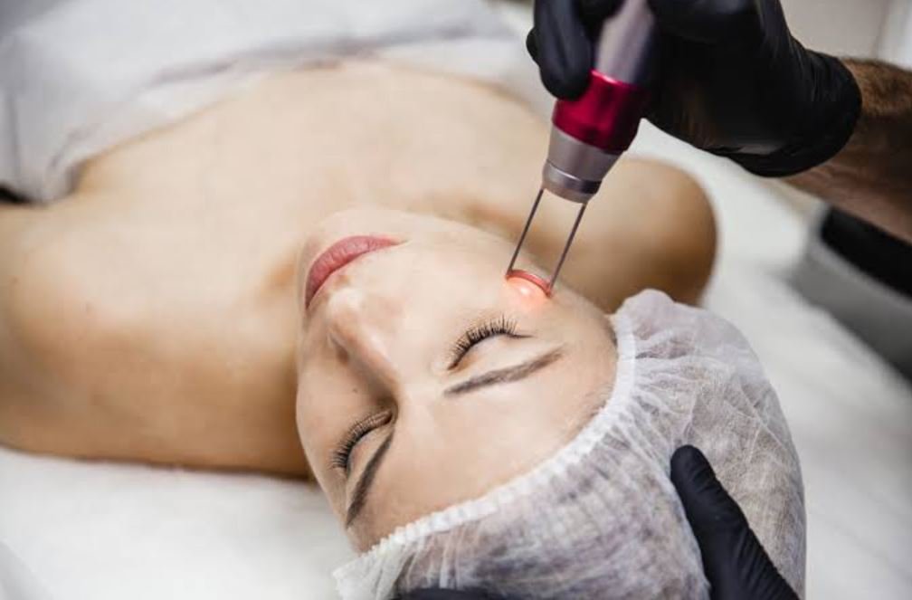 Photo Laser Facial: How This Treatment Improves Skin Tone and Texture