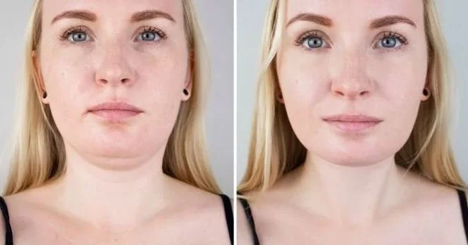 Are Fat Dissolving Injections an Effective Alternative to Chin Surgery?