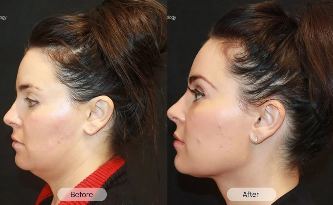Kybella Fort Lauderdale