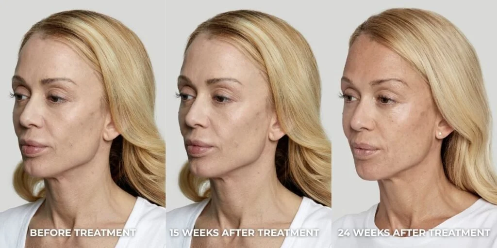 Botox vs Dermal Fillers vs Sculptra
