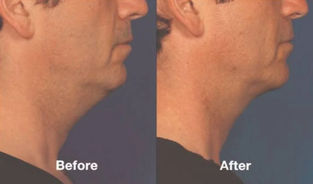 Kybella Fort Lauderdale