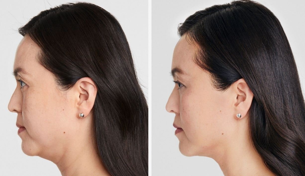 Ultherapy in Fort Lauderdale