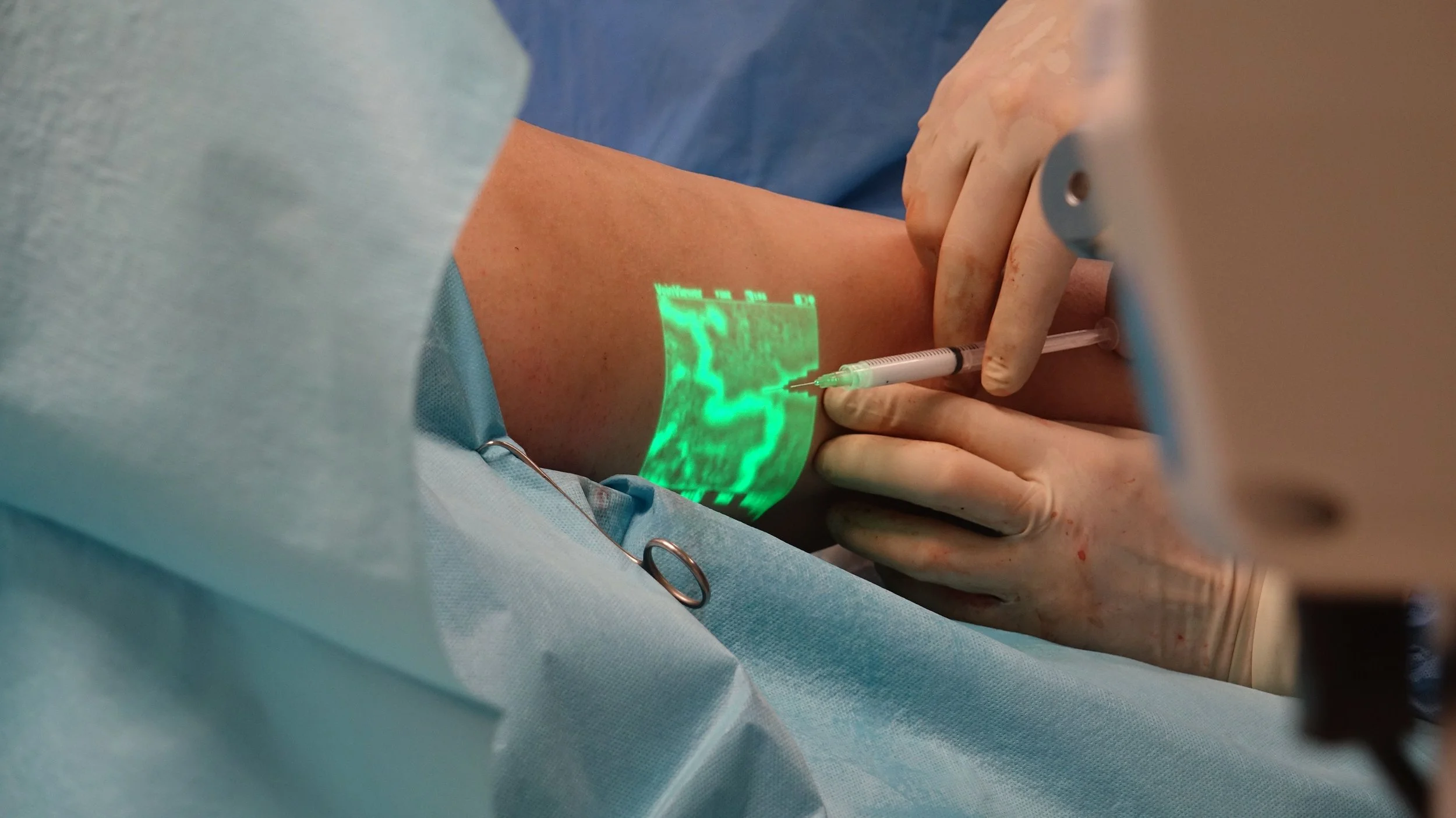 Understanding Foam Sclerotherapy