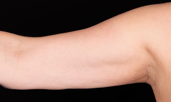 CoolSculpting arms post-treatment showing noticeable fat reduction and smooth tone.