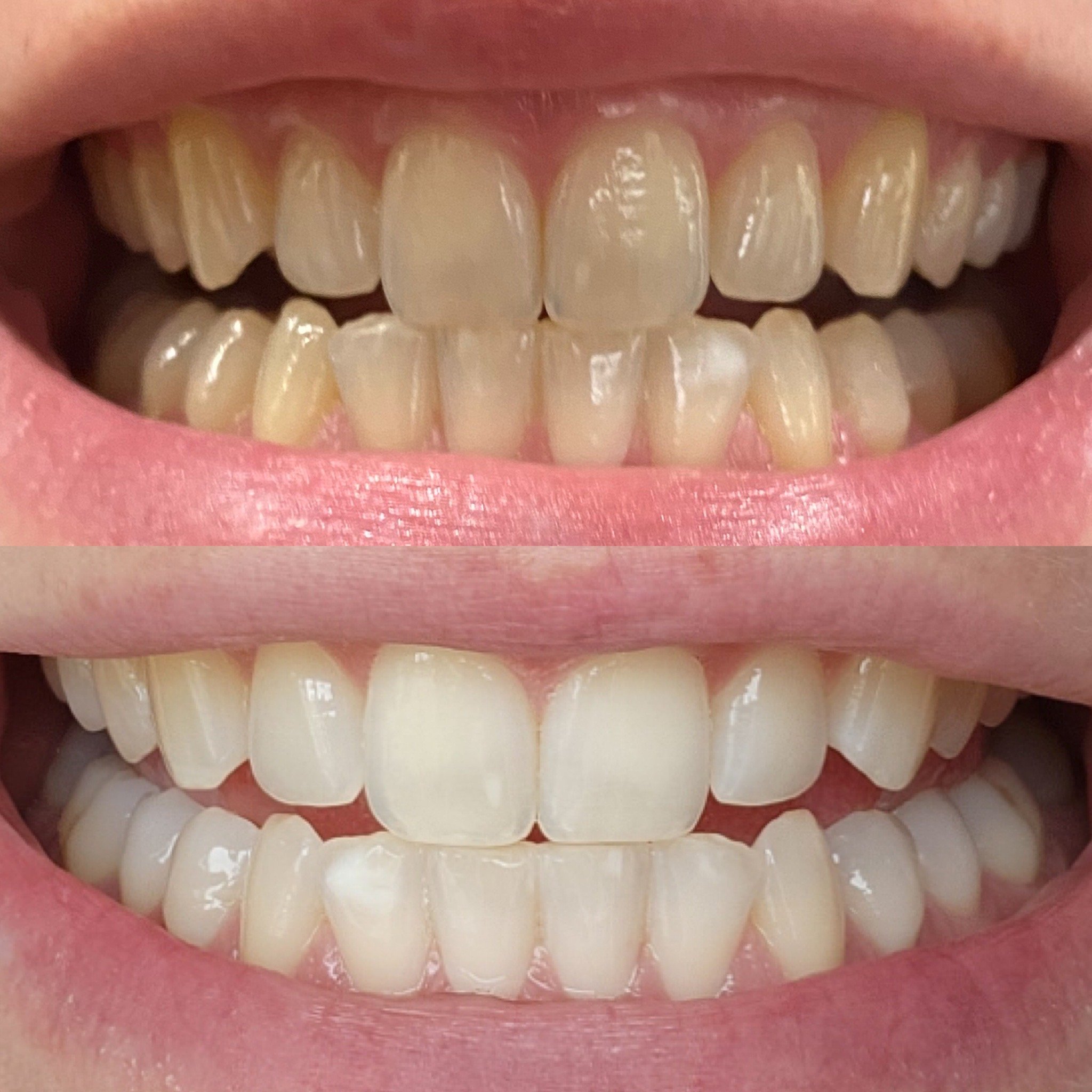 Teeth Whitening Treatment Cambridge