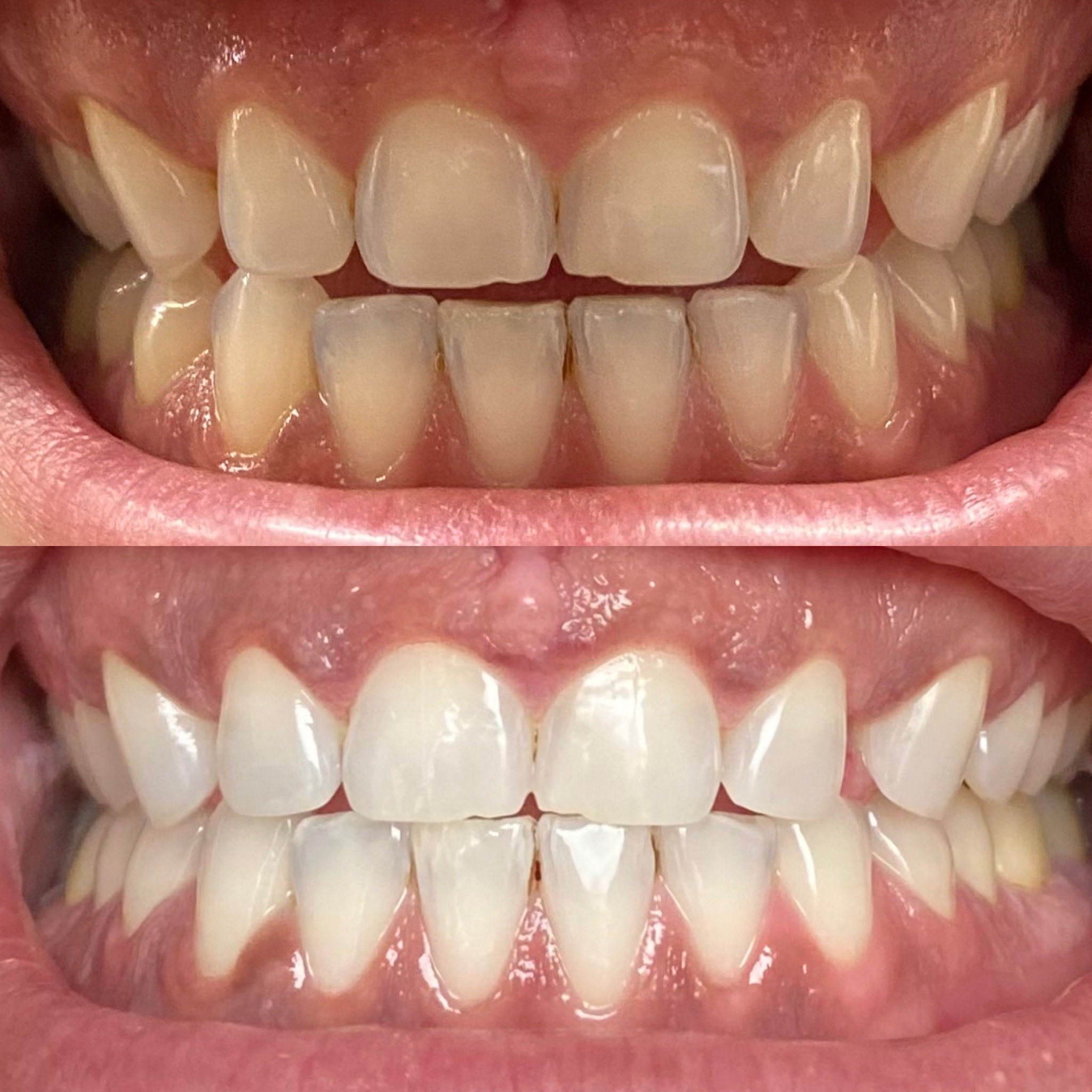 Teeth Whitening Treatment Cambridge