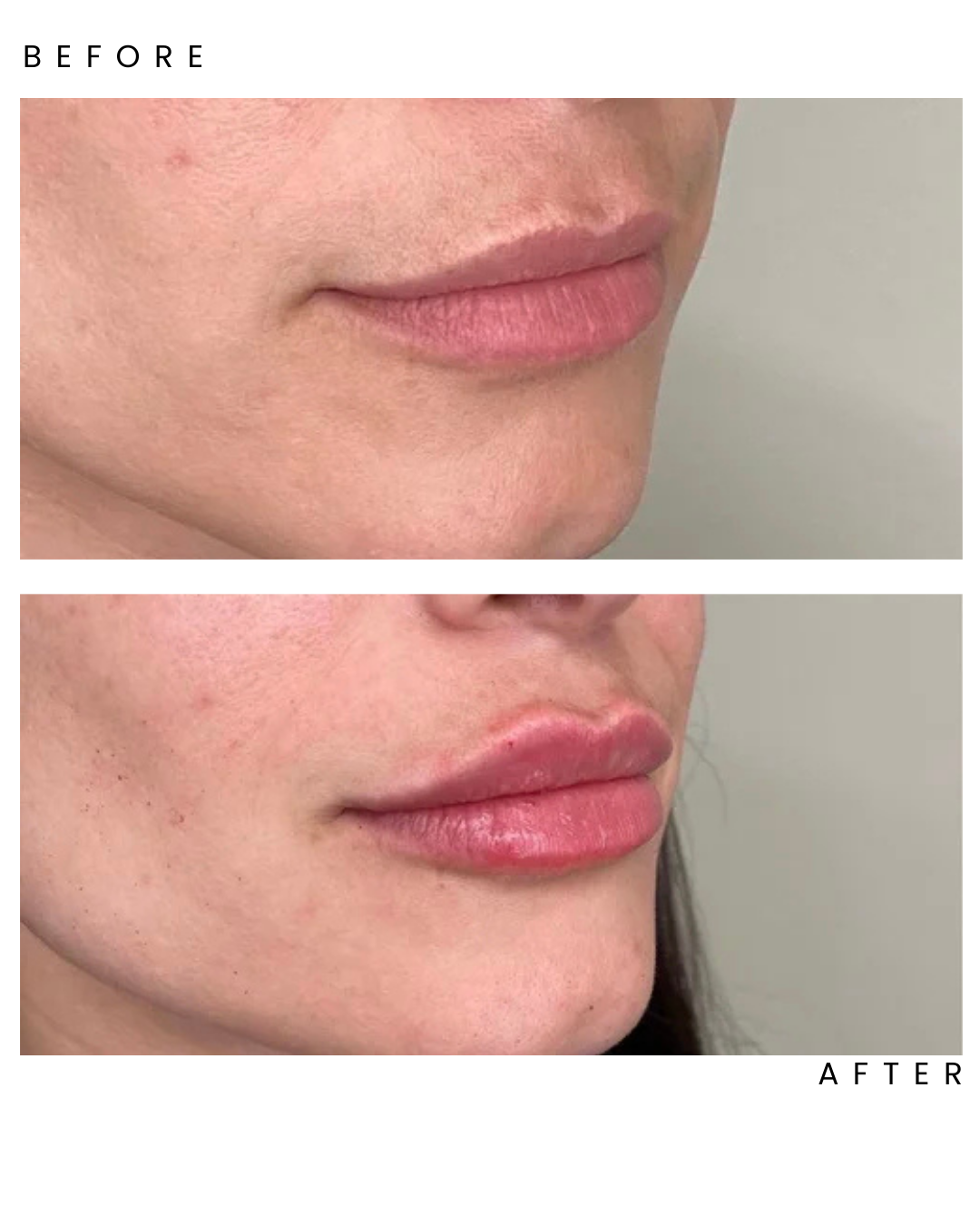 Fillers4.png