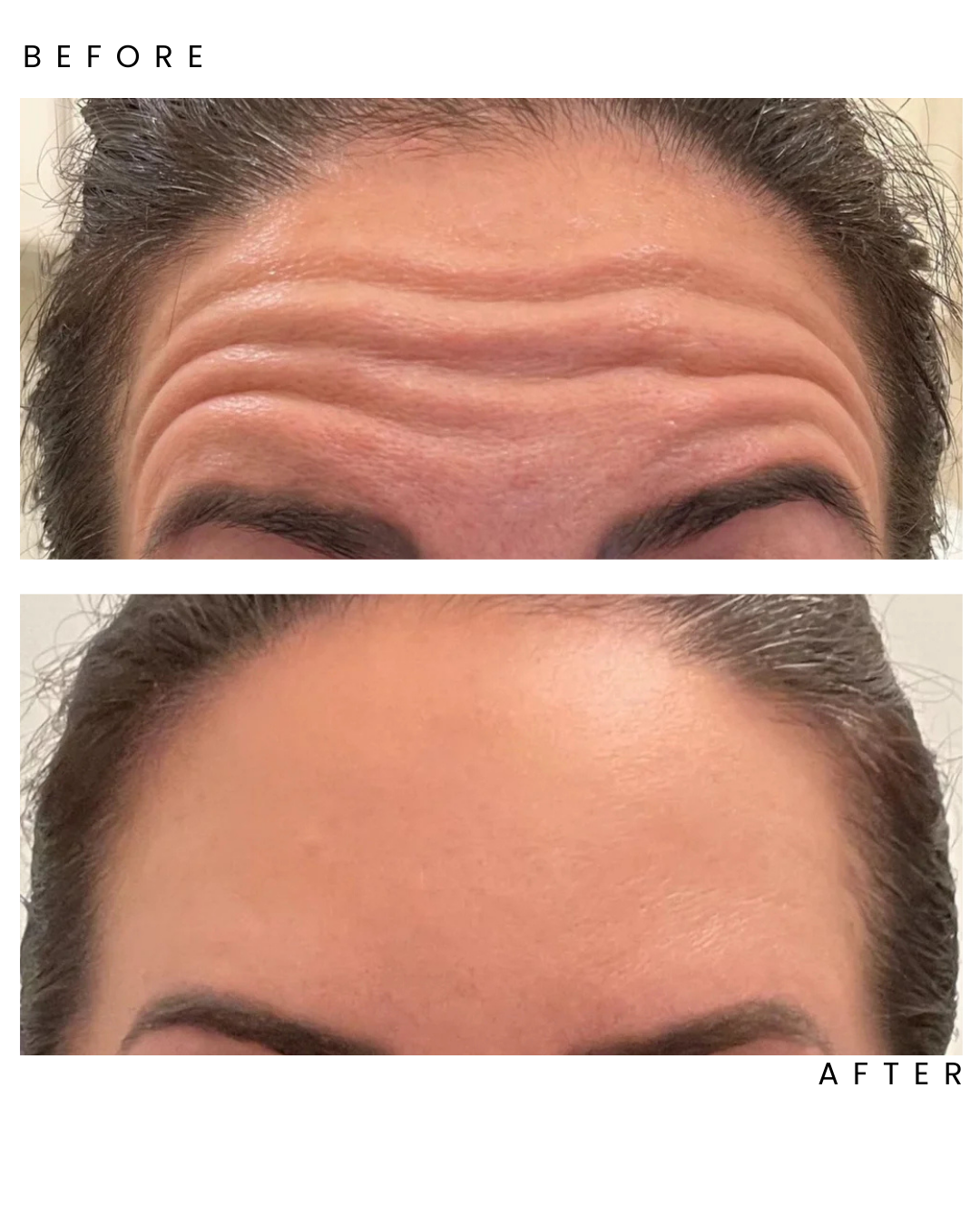 Fillers.png