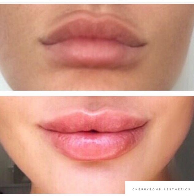 Procedure before and after CherryBomb Aesthetics 07505490127