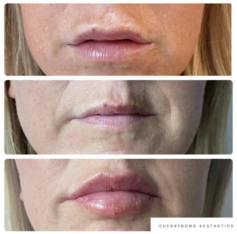 Procedure before and after CherryBomb Aesthetics 07505490127