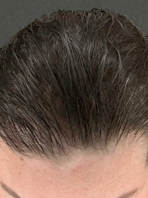 After Calecim hair loss treatment showing fuller-looking coverage and reduced scalp visibility at the front hairline.