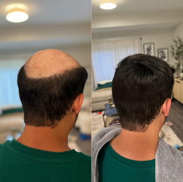 Reclaim Your Confidence: Solutions for Hair Loss, Fine and Thinning Hair 