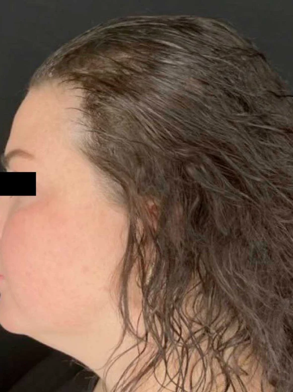 After Calecim hair loss treatment showing fuller-looking side hair coverage and reduced scalp visibility.