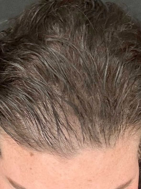 Before Calecim hair loss treatment showing visible scalp and reduced hair density along the front hairline.