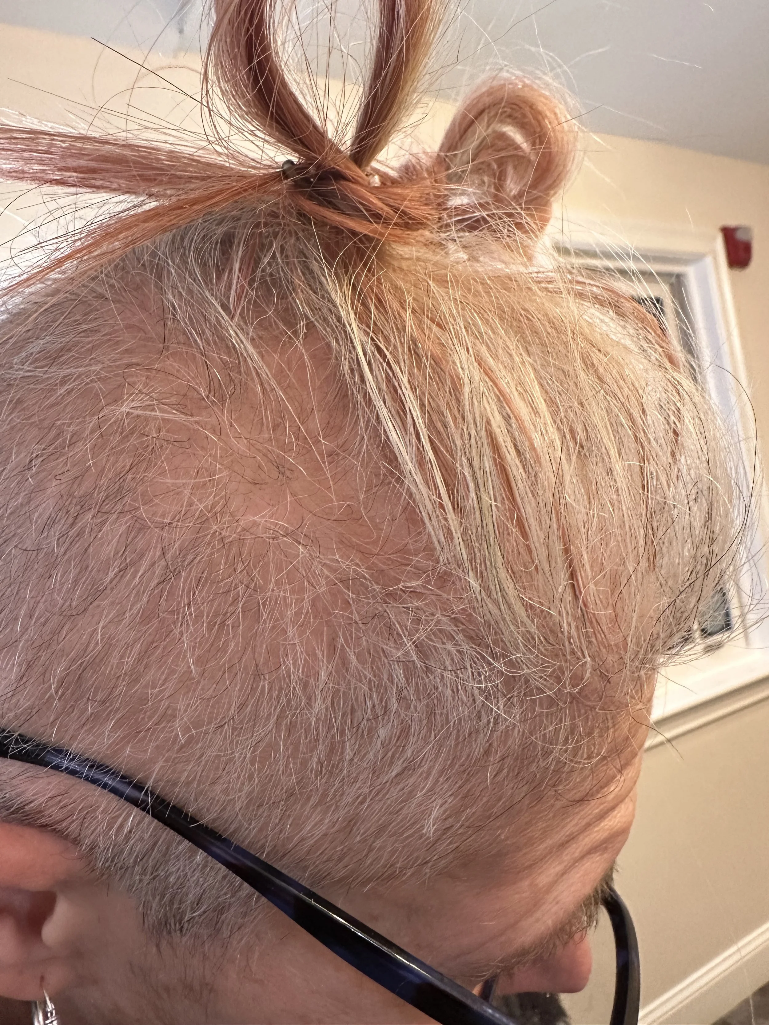 Close-up of a woman with blonde and copper-toned hair showing significant hair thinning and visible scalp along the side and crown, highlighting fine hair and hair density concerns addressed by TEAL Hair & Makeup Studio.