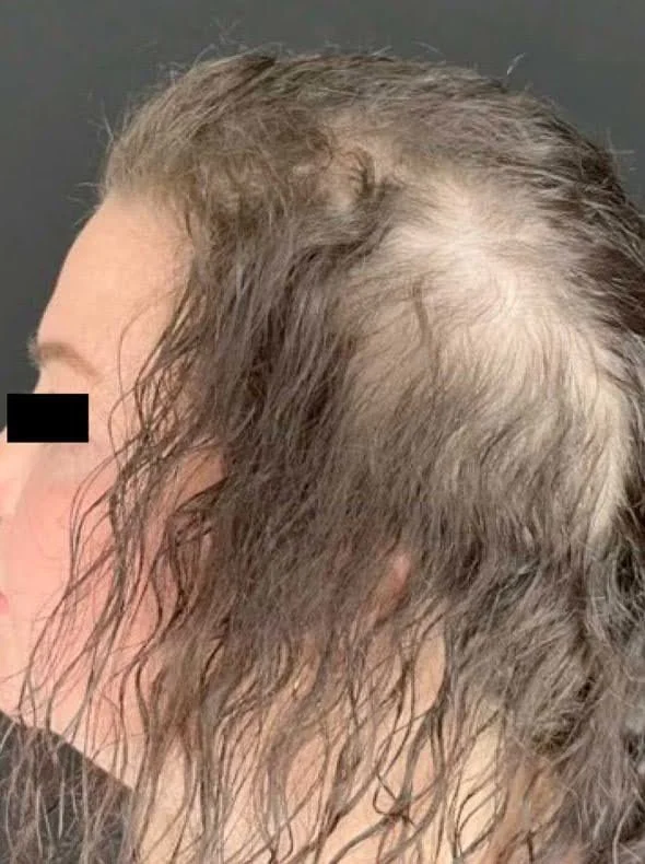 Before Calecim hair loss treatment showing visible scalp and reduced hair coverage along the side and top of the head.