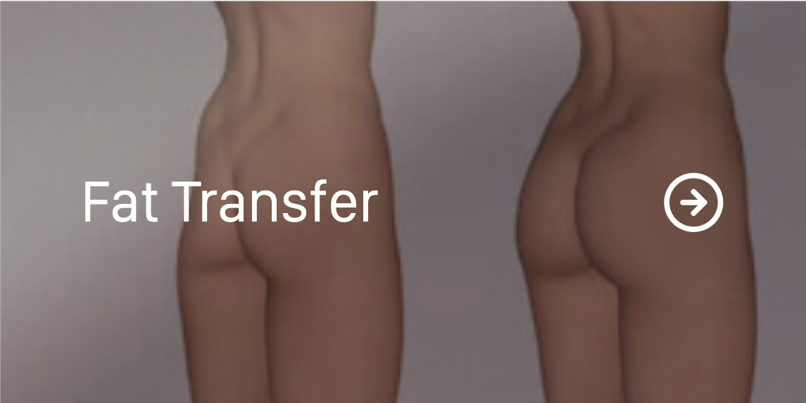Fat Transfer.png