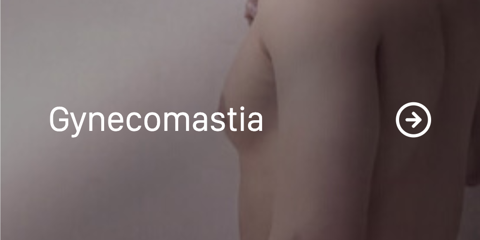 Gynecomastia.png