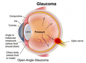 Glaucoma