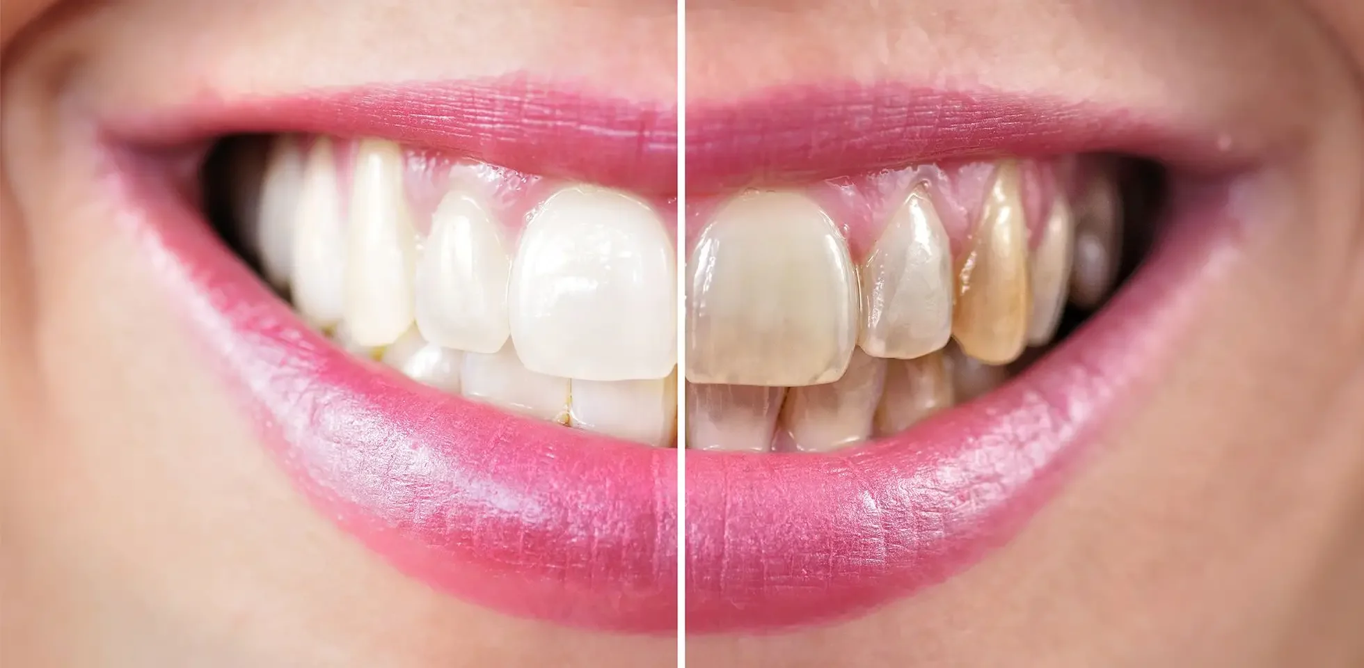 Teeth Whitening New York: Before &amp; After Results That Feel Real