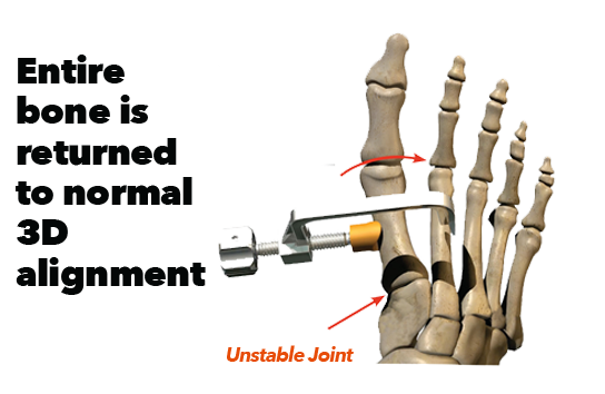 Lapiplasty® 3D Bunion Correction