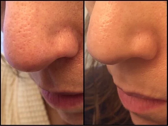 Microneedling for pores