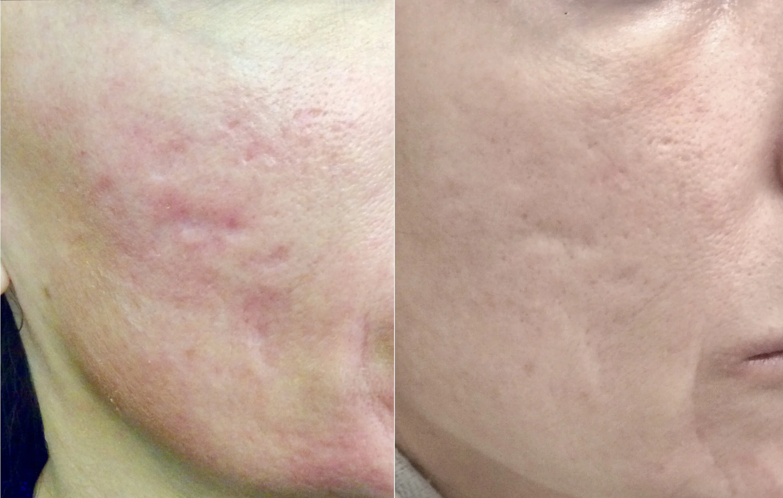 Microneedling for scarring