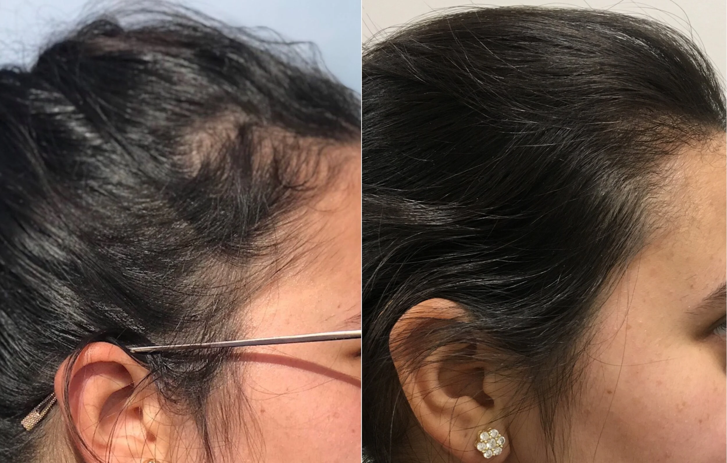 PRP for hairloss