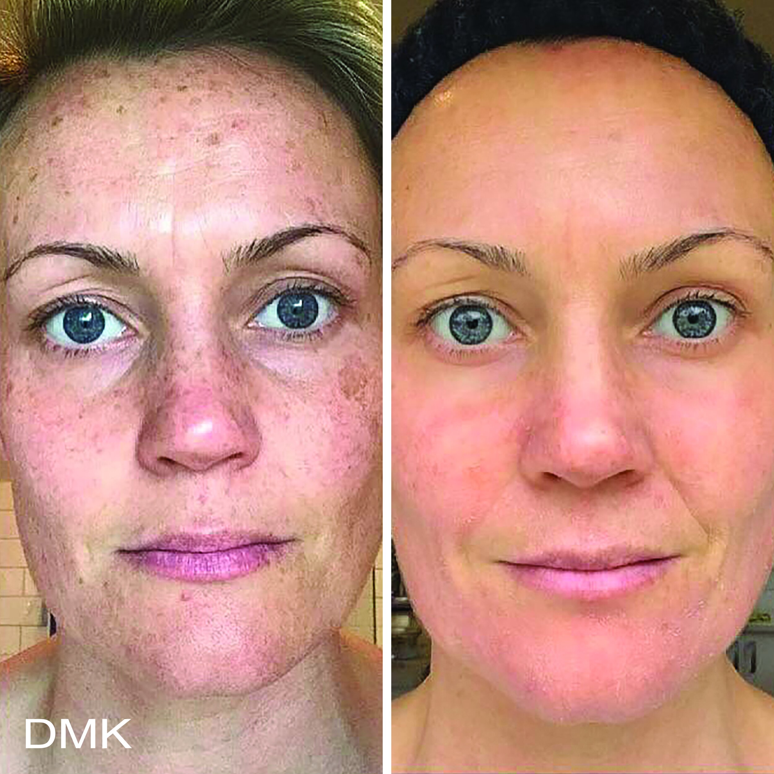 670073465MyDMKBrandedBeforeandAfterImageryPigmentation2300dpi.jpg