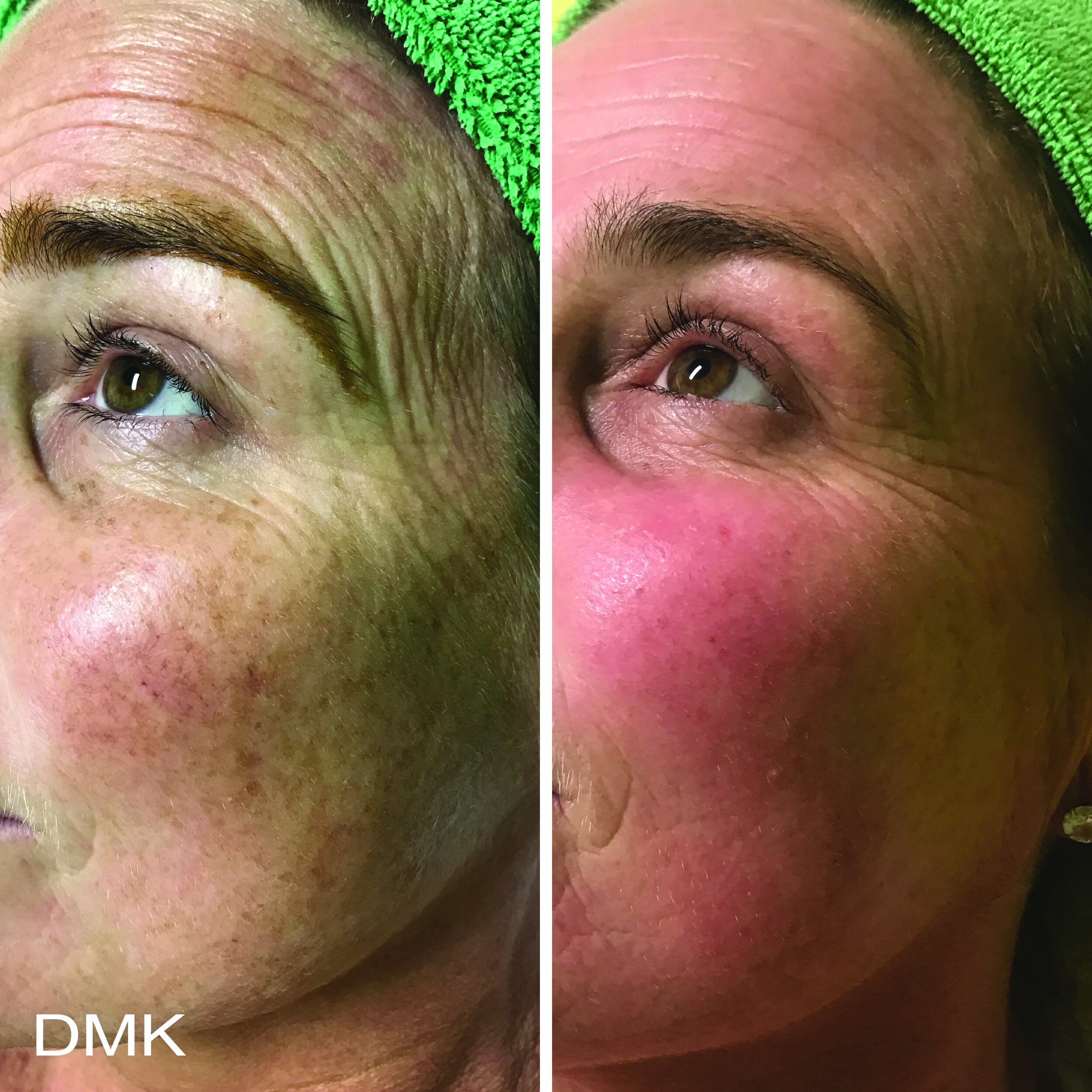 1775422665MyDMKBrandedBeforeandAfterImageryPigmentation10300dpi.jpg