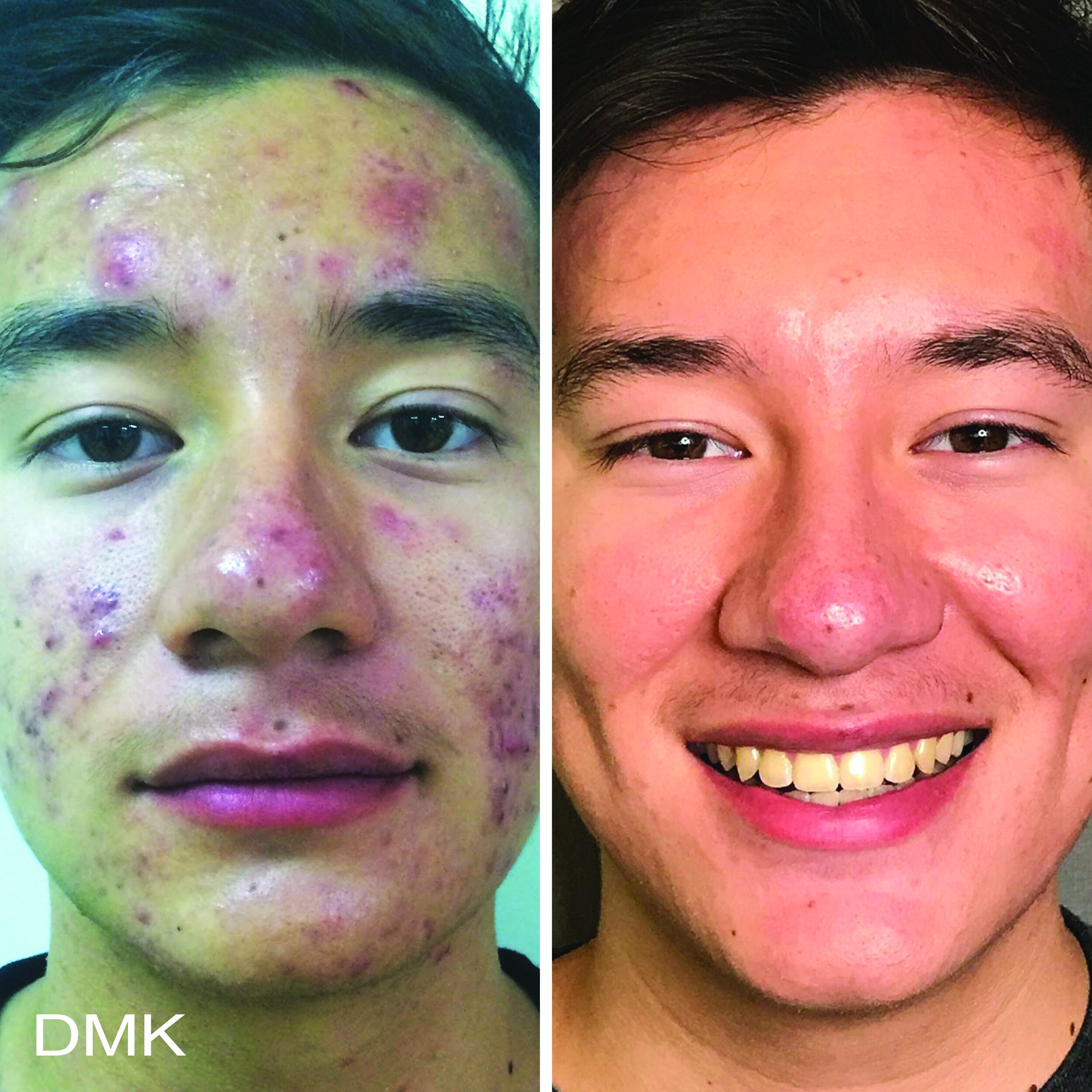 129624802MyDMKBrandedBeforeandAfterImageryAcne12300dpi.jpg