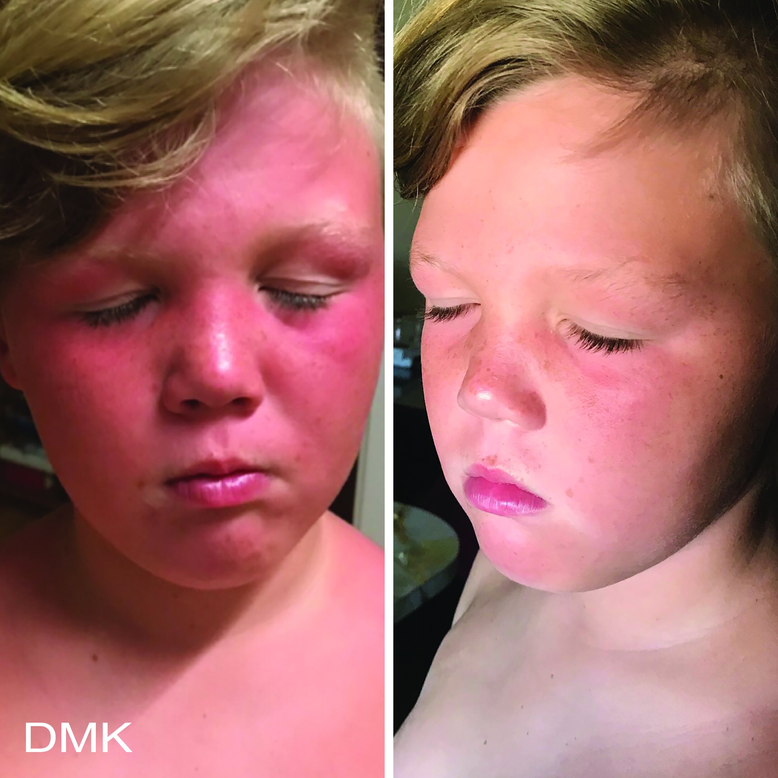 164633596MyDMKBrandedBeforeandAfterImageryDMKBetaGel2300dpi.jpg