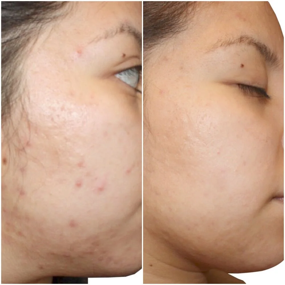 Laser Ipl Acne atelieryuwa.ciao.jp