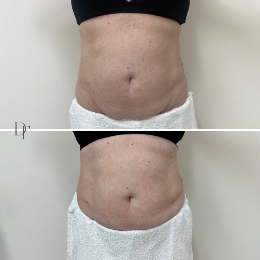 ✨ BLISS BODY CONTOURING ✨⁠
⁠
How amazing is this transformation, this beautiful client had 3 Bliss Body Contouring Treatments 👌🏼⁠
⁠
With Bliss Body Contouring, we can target stubborn fat cells and loose skin in the following areas: ⁠
- Abdomen (upp