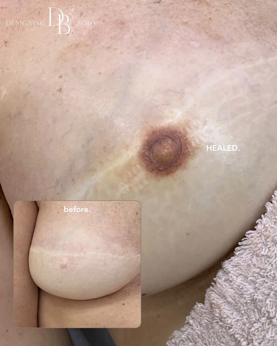 HEALED AREOLA TATTOO 🫶🏼
How beautiful is this transformation! 
We believe everyone deserves to feel truly confident in their skin and be their true authentic self. 
📍Newcastle
📩 DM for bookings 
Looking for cosmetic tattooing? Follow u