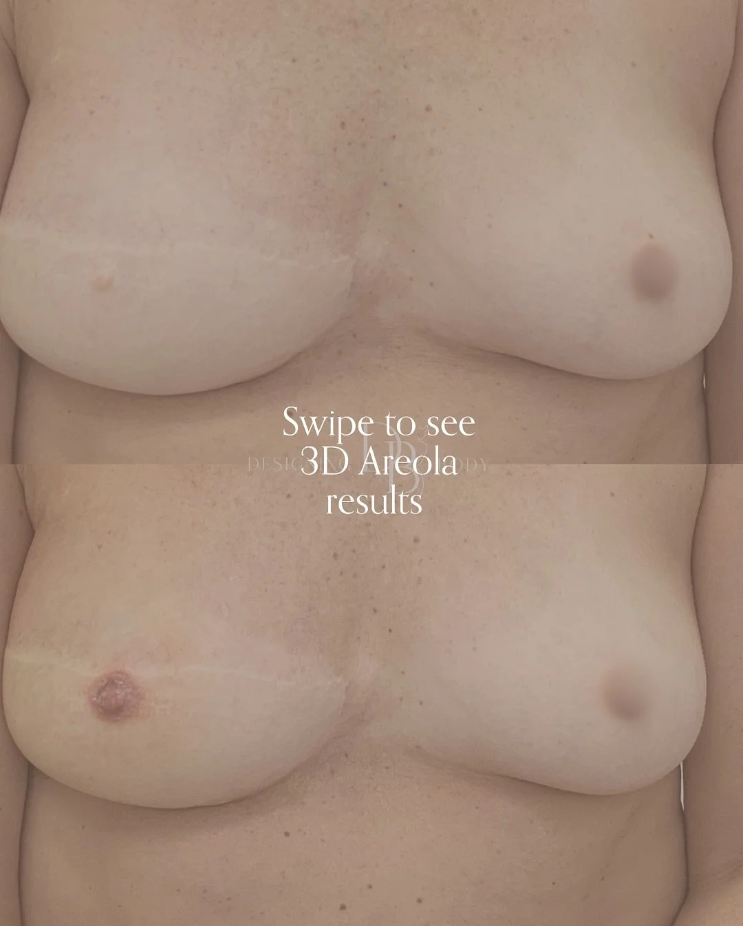 What an amazing transformation 😮‍💨 3D Areola Tattoo 
During the procedure day we will create the most realistic and sophisticated nipple tattoo. The technique involves carefully choosing different layering colours that work with skin tone with