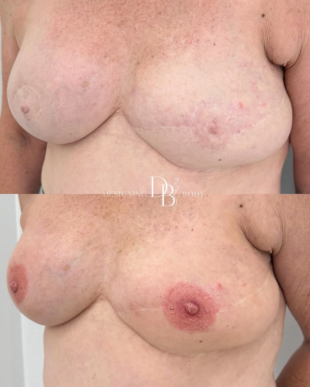 The power of Paramedical Tattooing 🙌🏽✨
We are so excited to share these amazing results after ONLY ONE treatment 🙌🏼
*DISCLAIMER✨ This is a tattoo! Please DO NOT report* 
—-
#areolatattoo #nippletattoo #areolanippletattoo #breastcanceraw