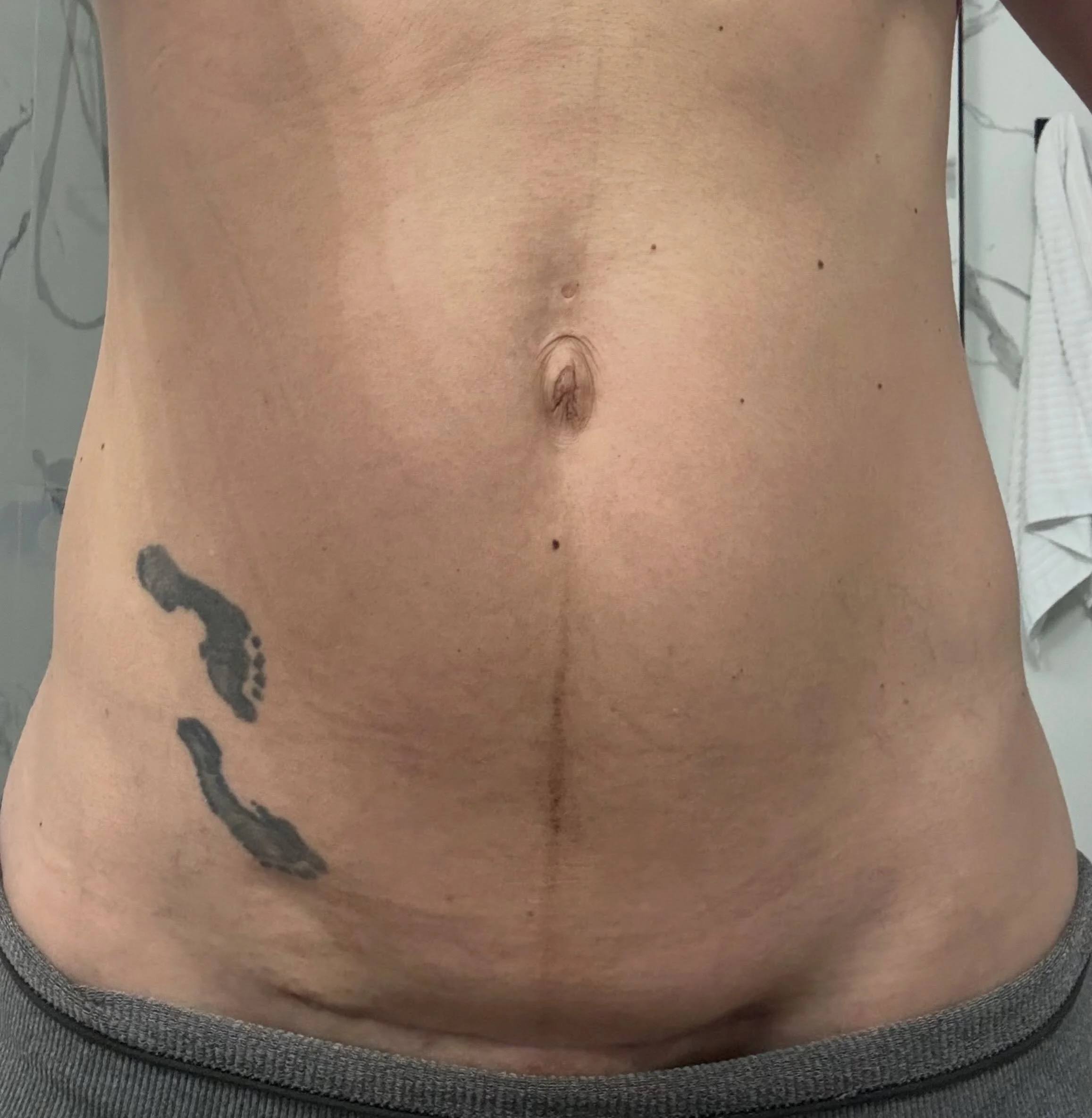 Two babies. Two C-sections. One scar that tells a story. ❤️

I knew motherhood would change my body. What I wasn&rsquo;t prepared for was how disconnected I would feel from it.

The pain. The recovery. The feeling that my core wasn&rsquo;t really min