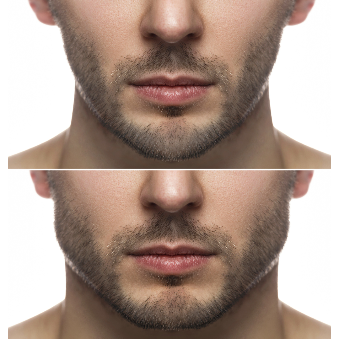 jawline contouring for men - Jeune Ascot Vale