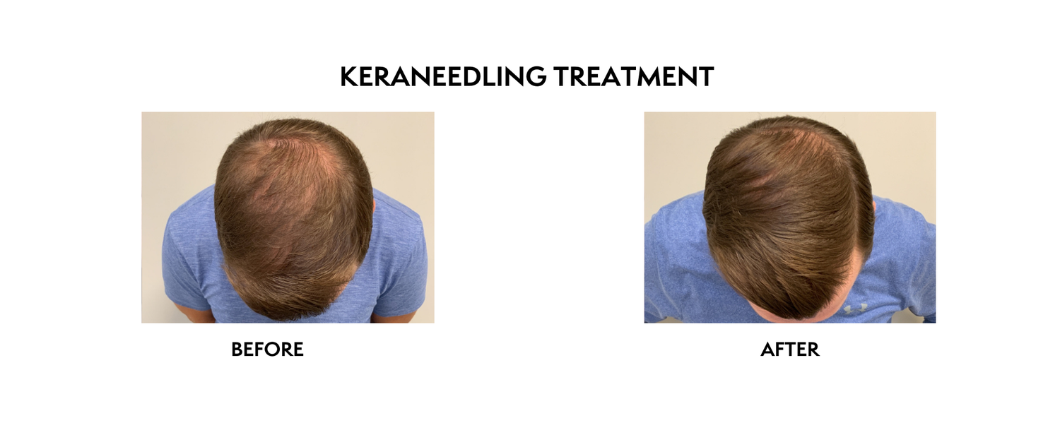 Kerafactor | Hair Growth Treatment | North Bethesda, MD