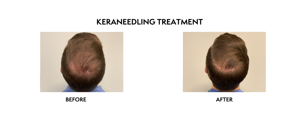 Kerafactor | Hair Growth Treatment | North Bethesda, MD