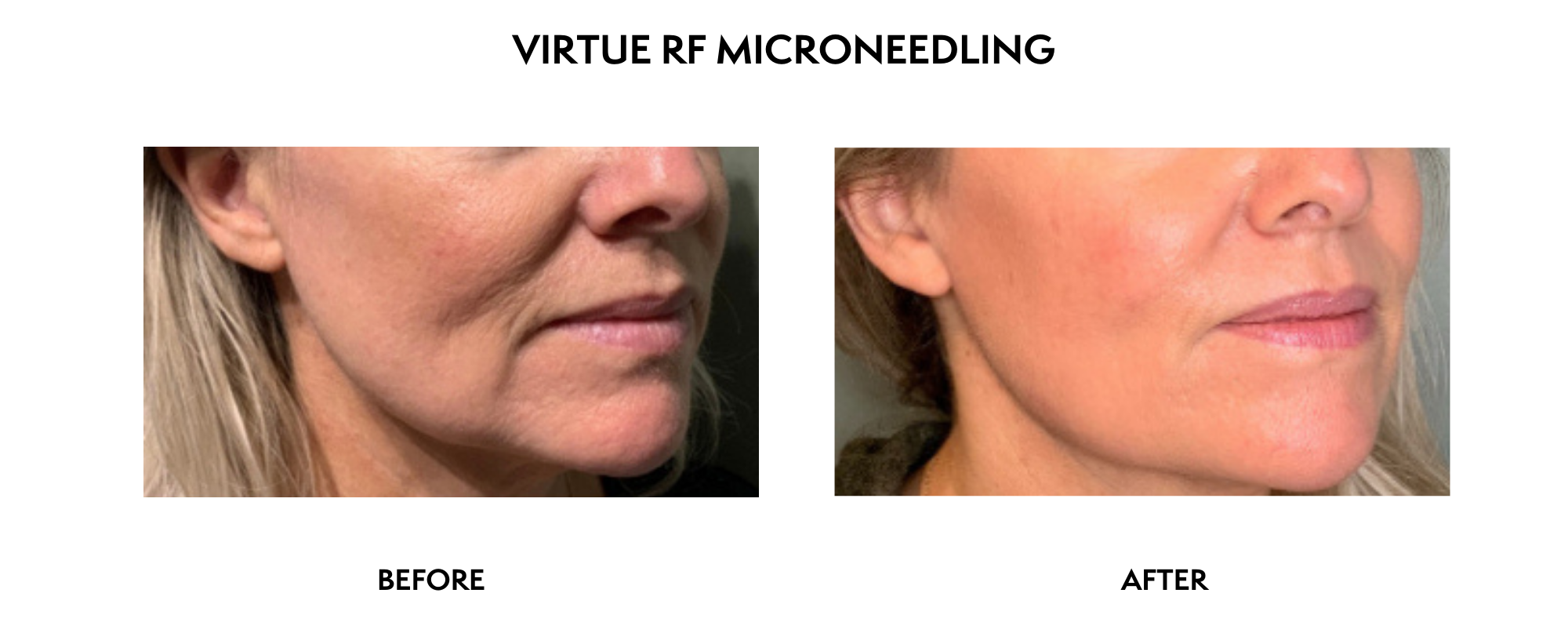 VIRTUE RF Microneedling North Bethesda, MD