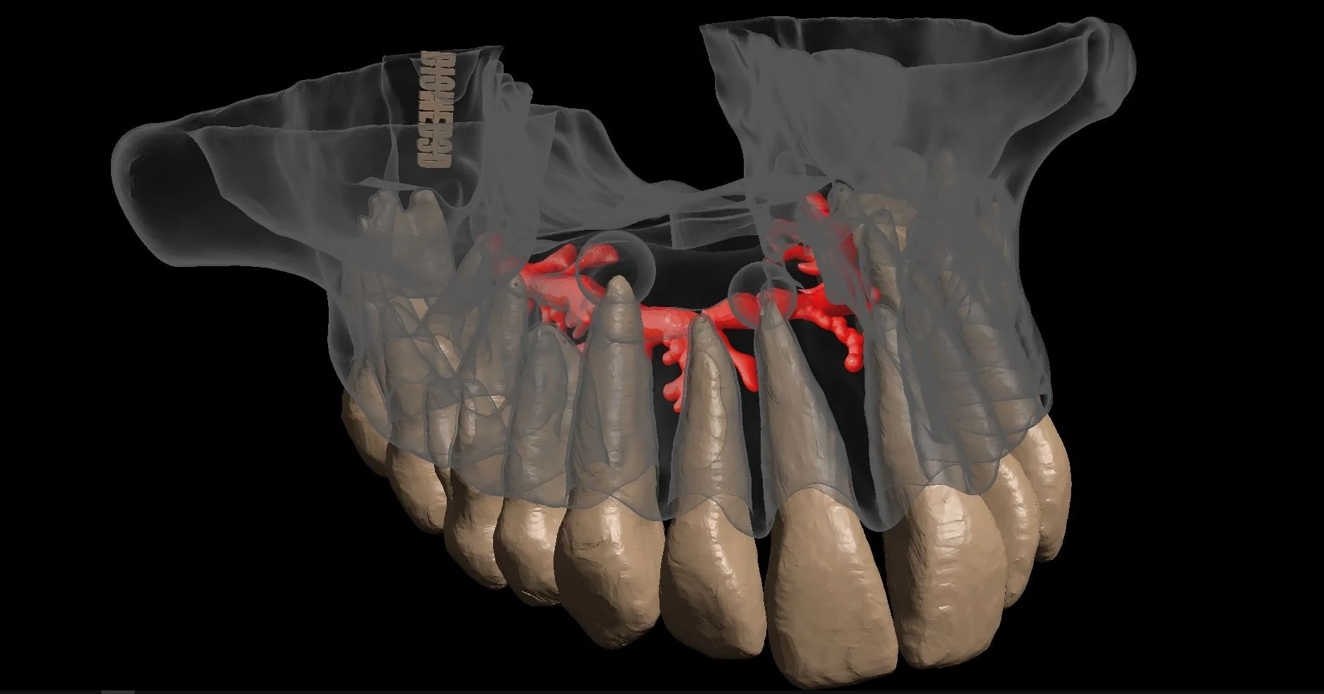We are enhancing our maxillary surgical model by incorporating anatomical canals and multiple peripheral lesions, including those extending into the sinus cavity. The model features areas of thickened tissue to simulate realistic pathology, providing