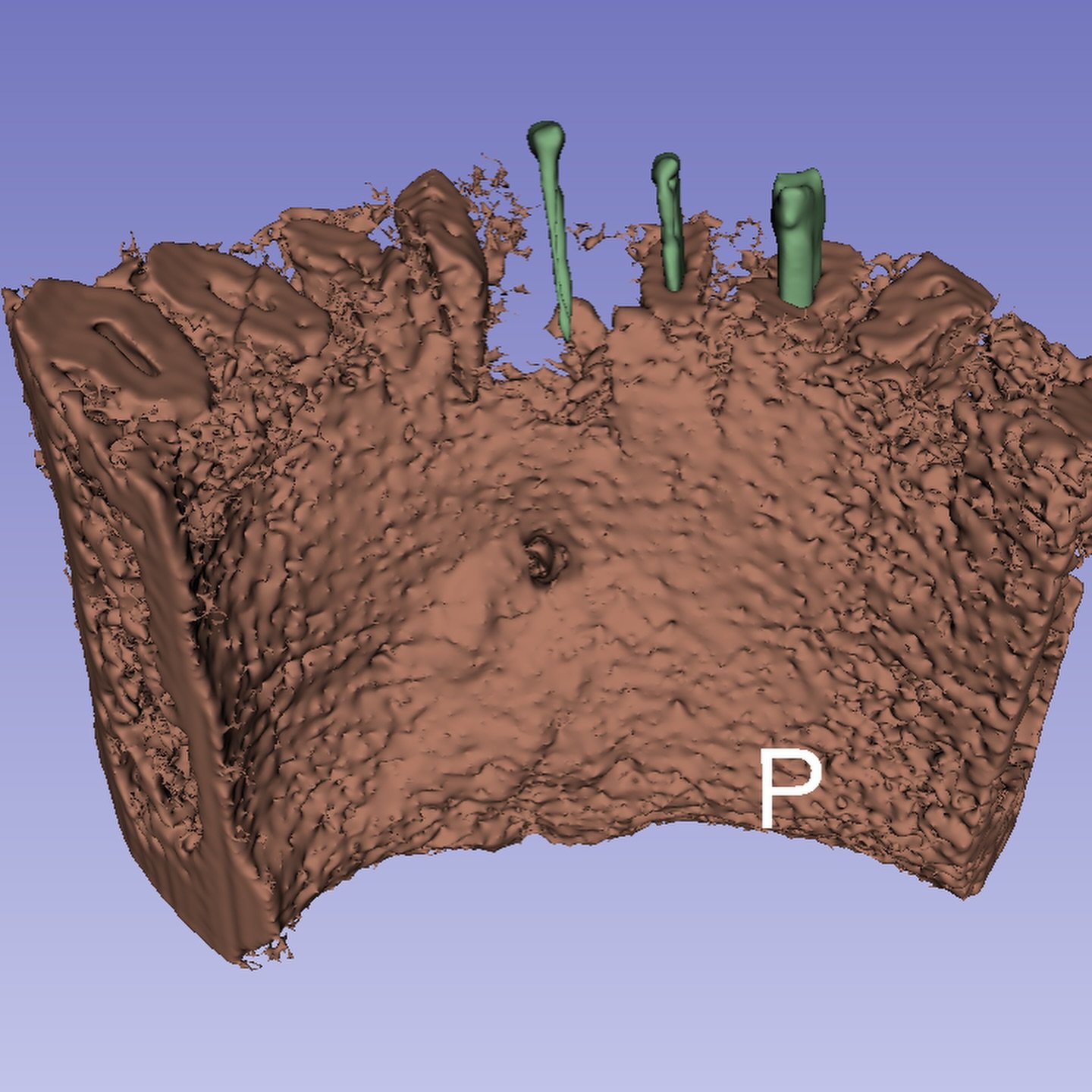 3 tooth lower apical surgery model design from patient CBCT data design getting started! Grabbing previously worked on teeth and gutta percha as well bone with large lesions. 

Will add tissue to follow + prototype print.