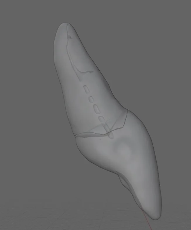 Custom Calcified maxillary central incisor 😍