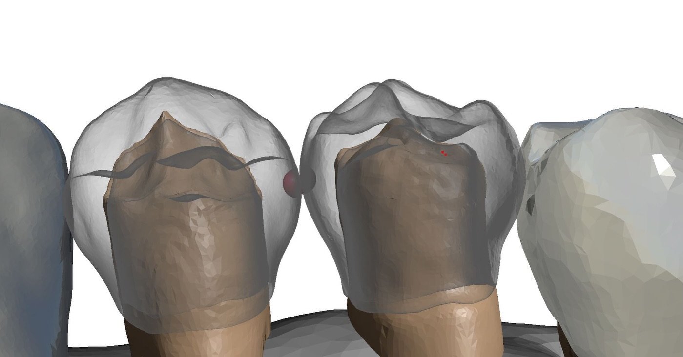 A mandibular jaw segment including teeth #27&ndash;31. This model should incorporate carefully designed incipient interproximal decay between the contact points to evaluate the detectability of early lesions. The interproximal lesions should mimic E1