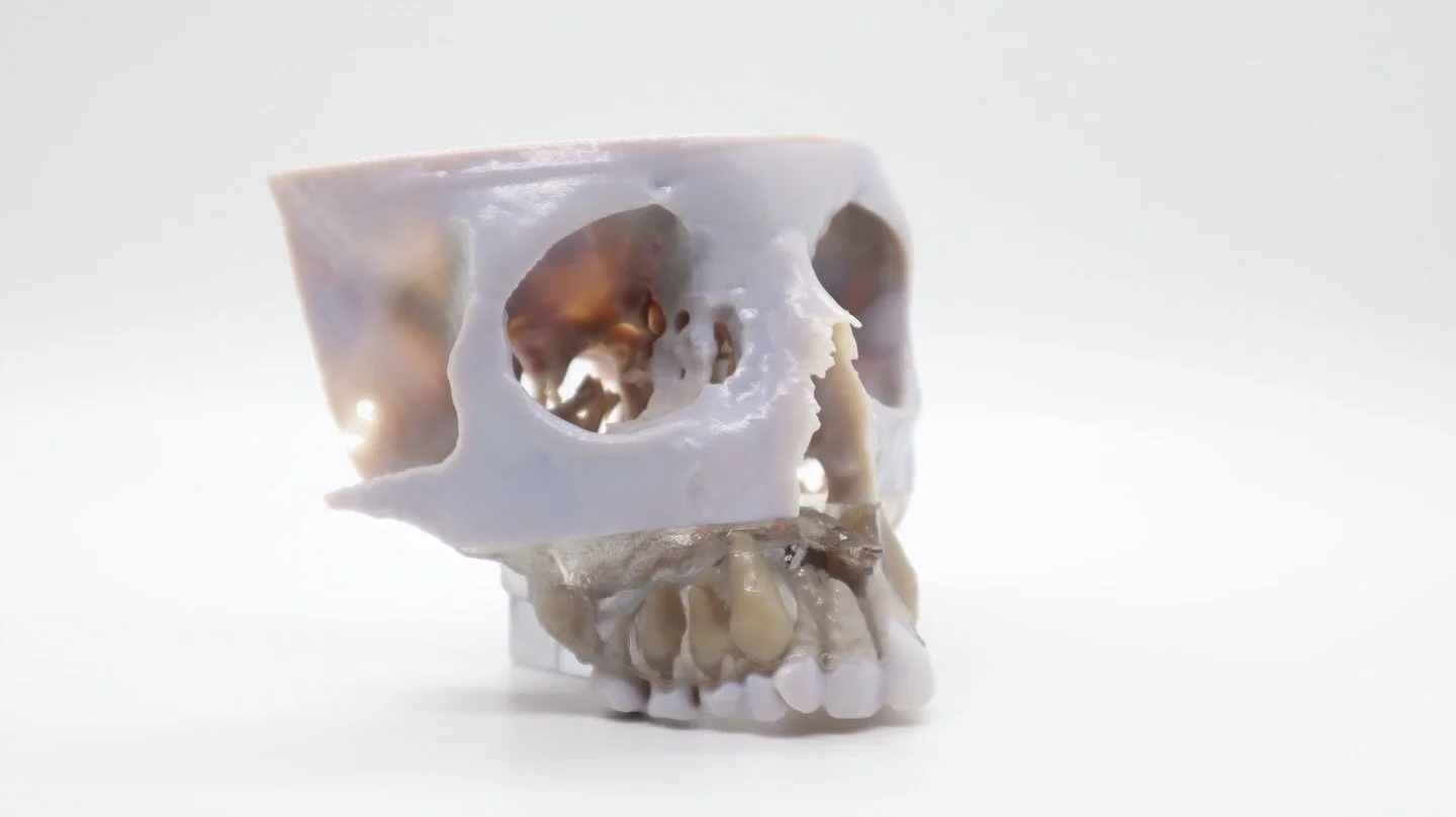 Palatal expansion 3D printed demonstration model of young patient 📈

#palatalexpansion #dental