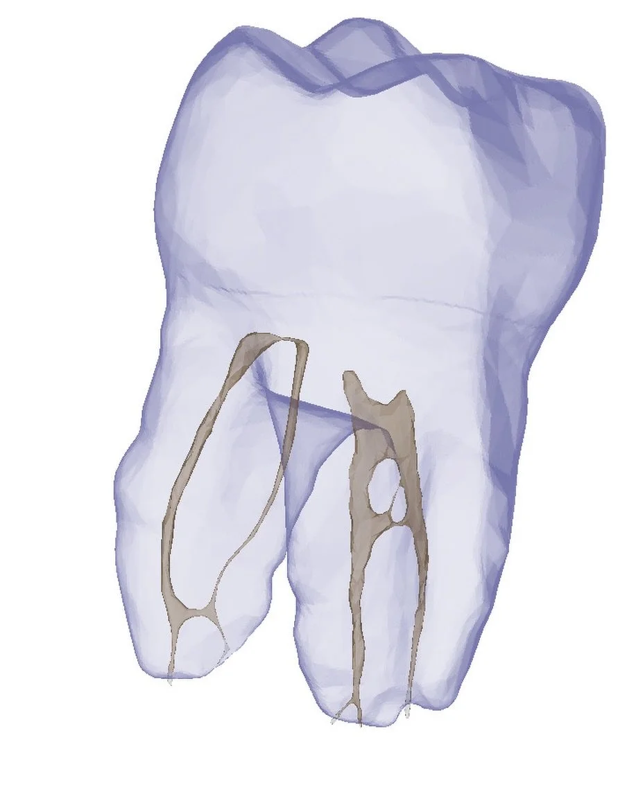Extra tight calcified canal at 0.06 diameter 🔥

Dm us to create your own. 

#calcifiedcanals #dentalstudent