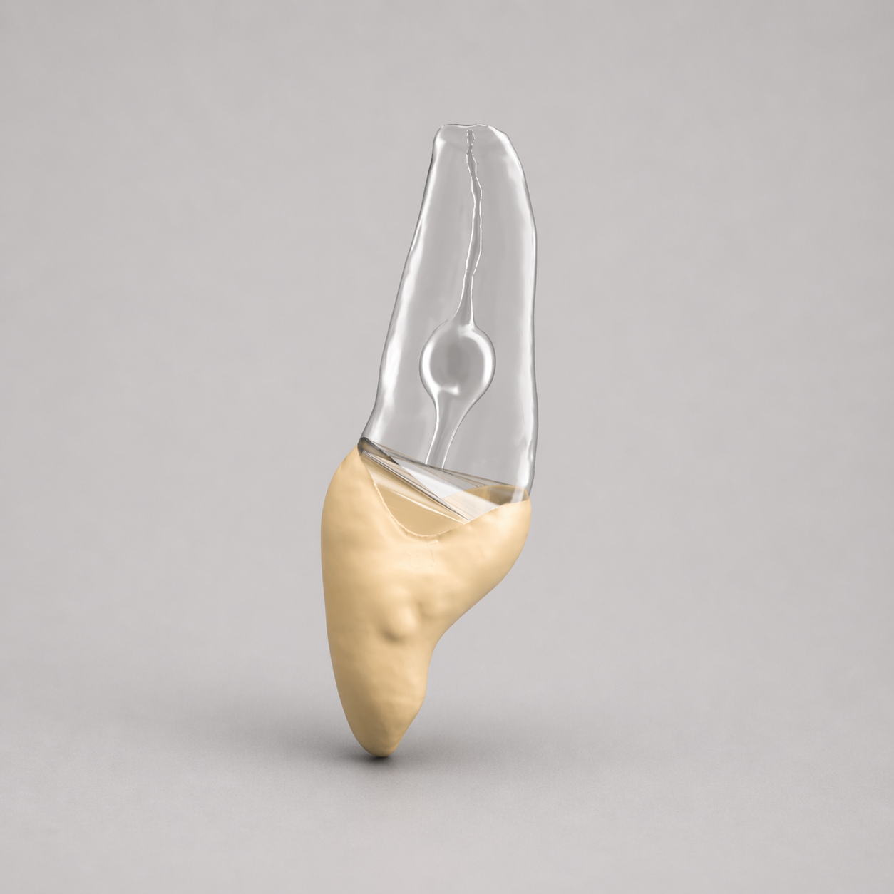 Tooth 9 With Internal Resorption (Upper Left Central Incisor)
